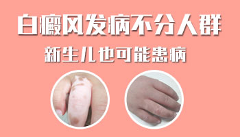 婴儿会得白癜风吗 白癜风怎么治