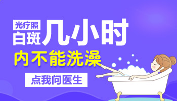 手指白癜风照完308隔几个小时可以洗澡