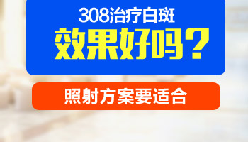 白癜风不吃药光照光行吗