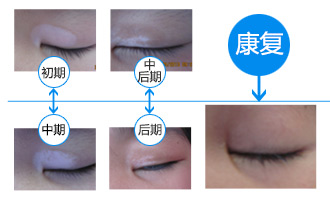 眼周白癜风照完308激光肿了咋回事