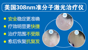 石家庄远大白癜风医院的激光是美国进口的吗