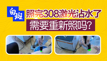 308照完光白斑多久不能碰水