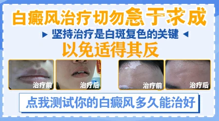 土方法无花果治白斑 专注治疗白斑的医院