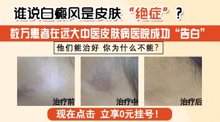 石家庄去除白斑正规的医院有