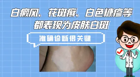 孩子身上白斑是不是得了白癜风