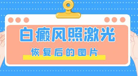 石家庄专治儿童面部白斑医院