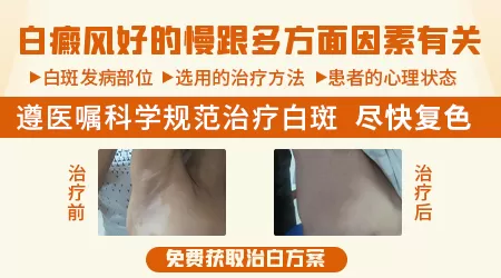 为什么手指白癜风照308好的慢