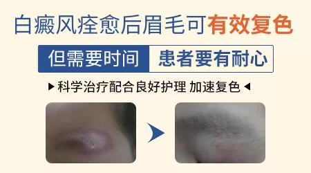 白癜风患者眉毛变白能拔掉吗