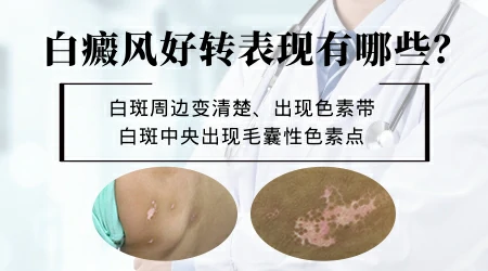 芦可替尼乳膏作用是什么