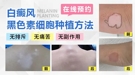 女性大腿白斑能做种植吗