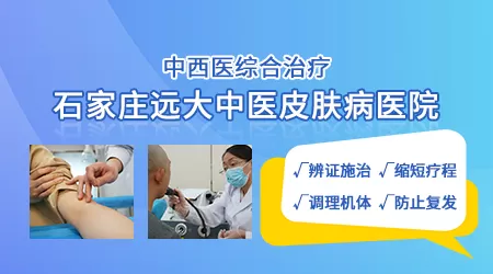 中医治疗白癜风有什么秘方吗