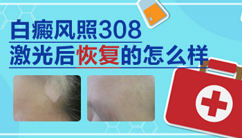 孩子眉头上有块白说是白癜风直接照308可以吗