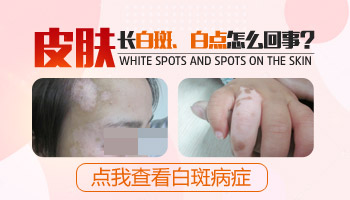 孕妇大腿上有好几块白点是什么