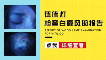 wood灯下白癜风图片