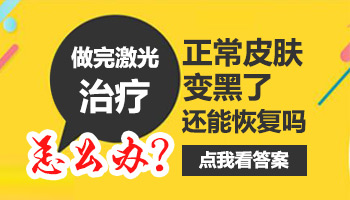 白癜风照光后周边皮肤变黑是剂量大吗