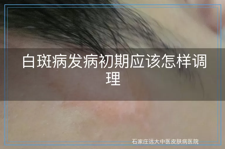 白斑病发病初期应该怎样调理