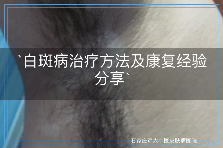 白斑病治疗方法及康复经验分享