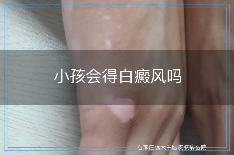 小孩会得白癜风吗