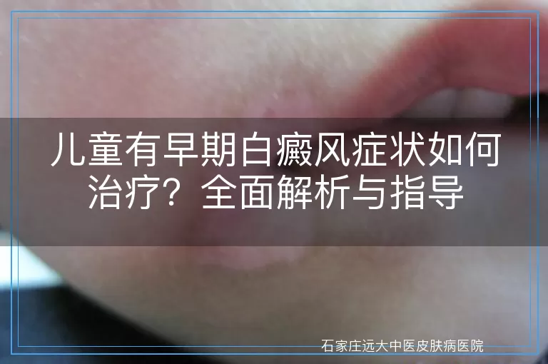 儿童有早期白癜风症状如何治疗？全面解析与指导