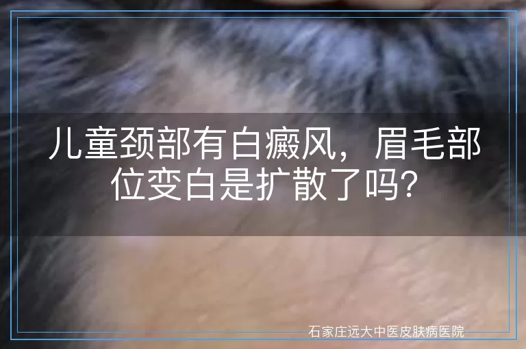 儿童颈部有白癜风，眉毛部位变白是扩散了吗？