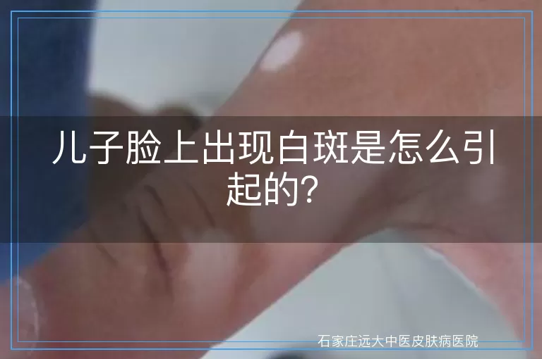 儿子脸上出现白斑是怎么引起的？