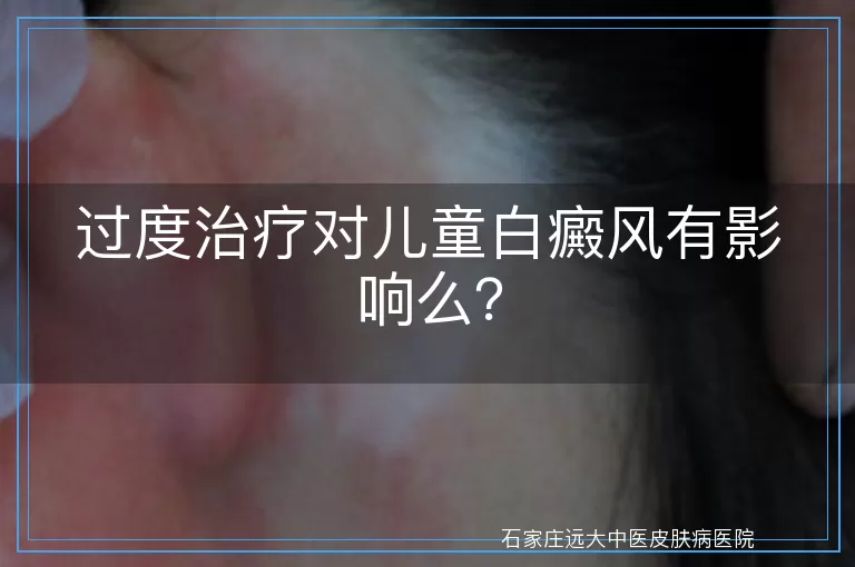 过度治疗对儿童白癜风有影响么？