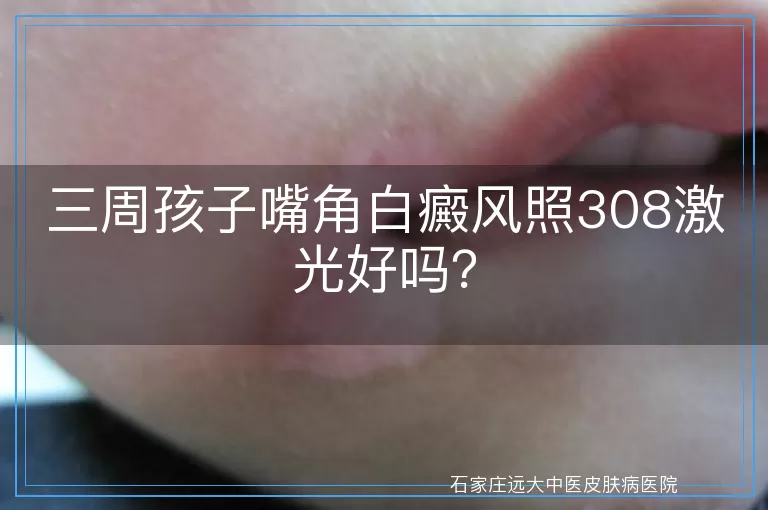 三周孩子嘴角白癜风照308激光好吗？