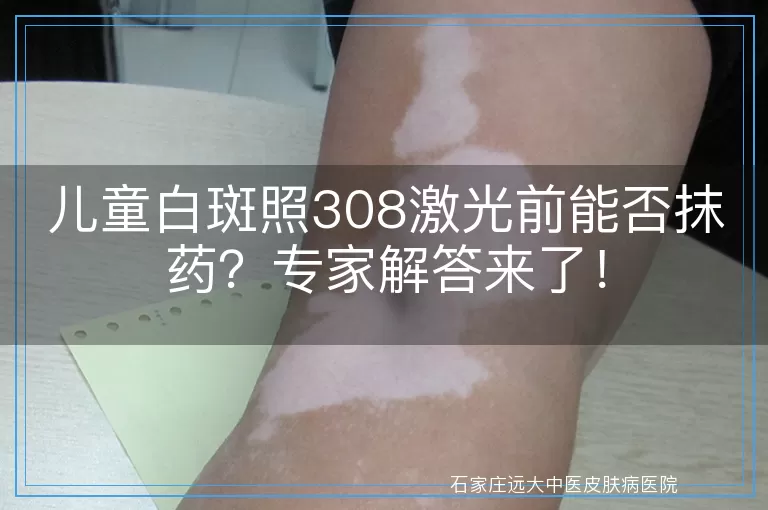 儿童白斑照308激光前能否抹药？专家解答来了！