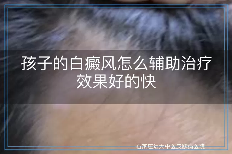 孩子的白癜风怎么辅助治疗效果好的快