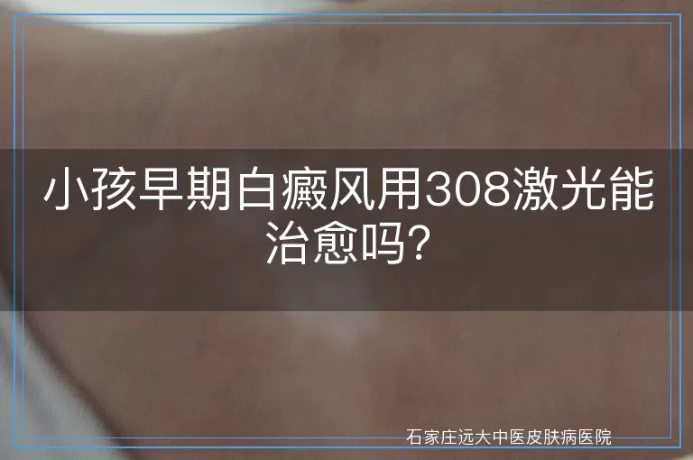 小孩早期白癜风用308激光能治愈吗？