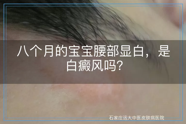 八个月的宝宝腰部显白，是白癜风吗？