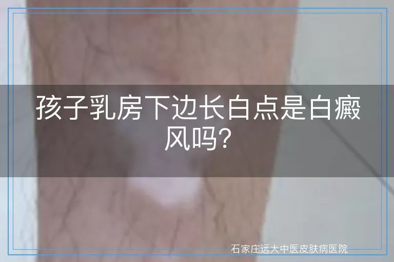 孩子乳房下边长白点是白癜风吗？