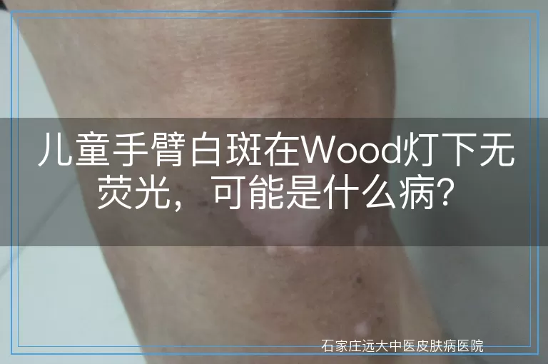 儿童手臂白斑在Wood灯下无荧光，可能是什么病？