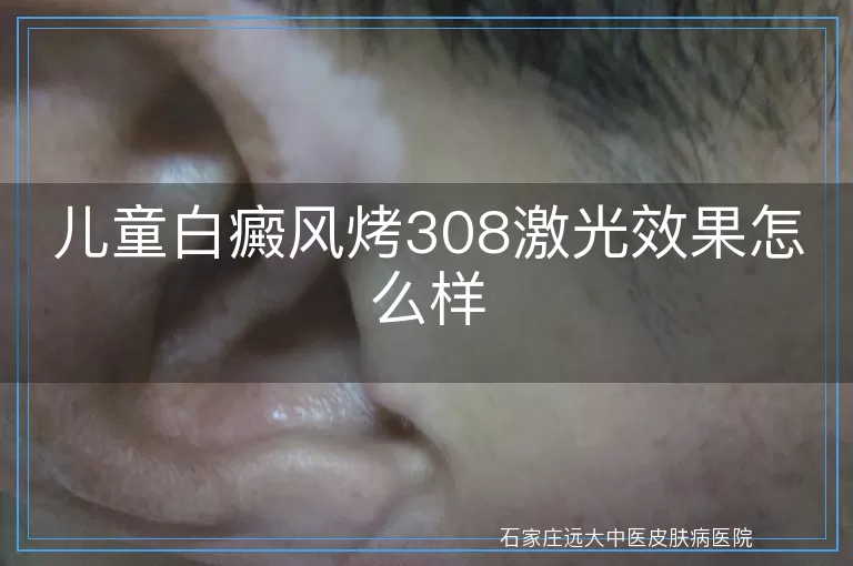 儿童白癜风烤308激光效果怎么样