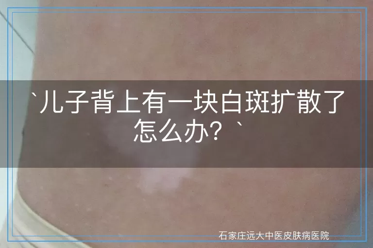 `儿子背上有一块白斑扩散了怎么办？`