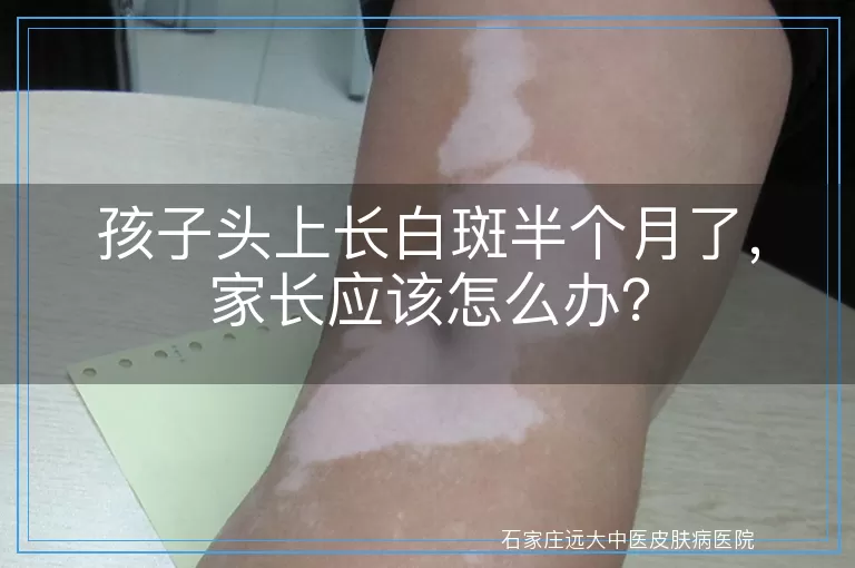 孩子头上长白斑半个月了，家长应该怎么办？