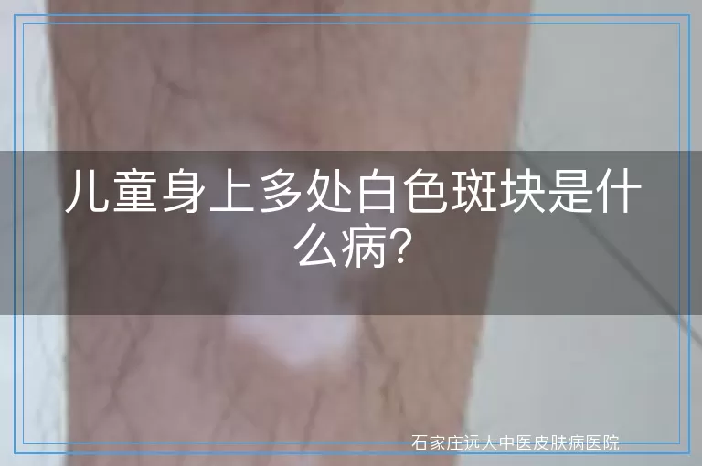 儿童身上多处白色斑块是什么病？