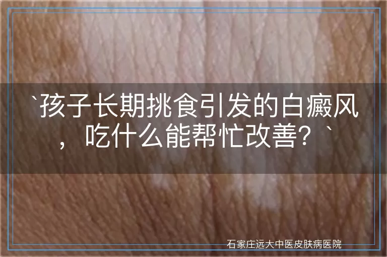 `孩子长期挑食引发的白癜风，吃什么能帮忙改善？`