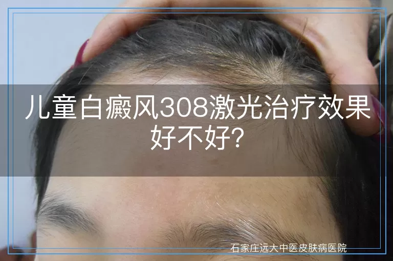 儿童白癜风308激光治疗效果好不好？