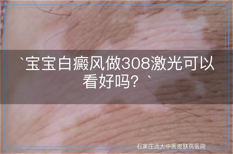 `宝宝白癜风做308激光可以看好吗？`