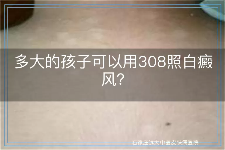 多大的孩子可以用308照白癜风？