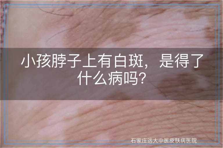 小孩脖子上有白斑，是得了什么病吗？