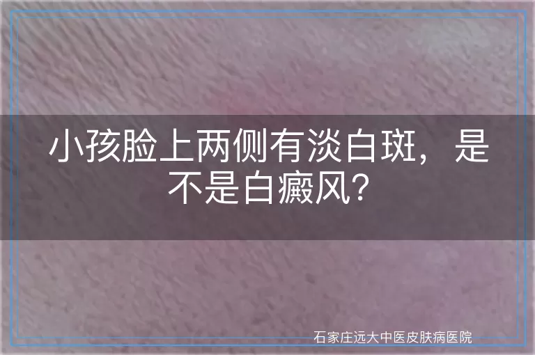 小孩脸上两侧有淡白斑，是不是白癜风？