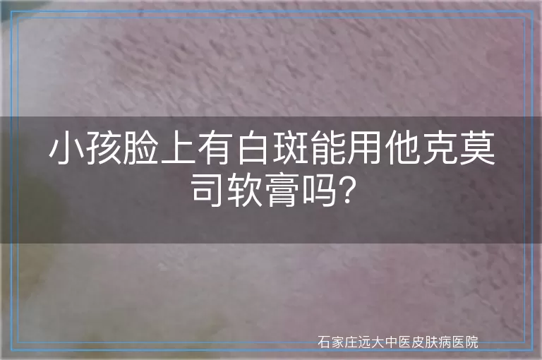 小孩脸上有白斑能用他克莫司软膏吗？