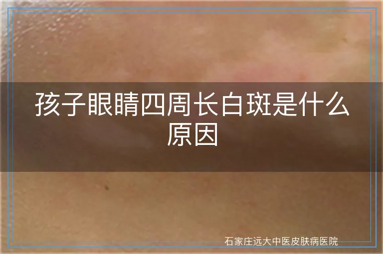 孩子眼睛四周长白斑是什么原因