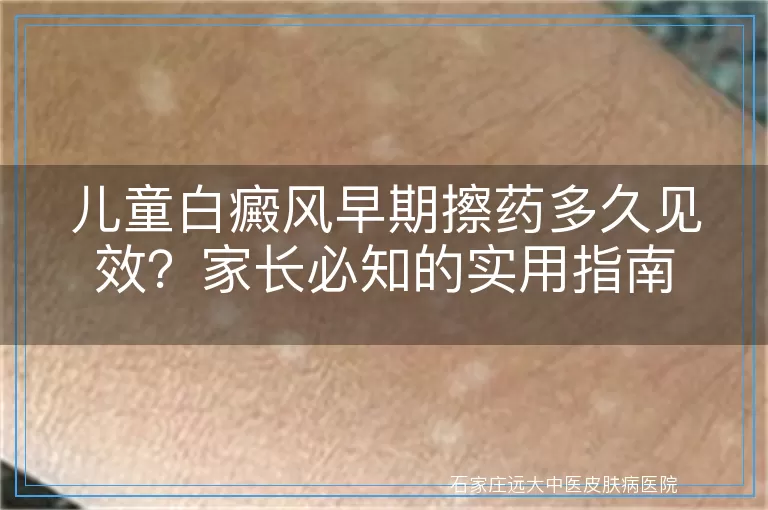 儿童白癜风早期擦药多久见效？家长必知的实用指南