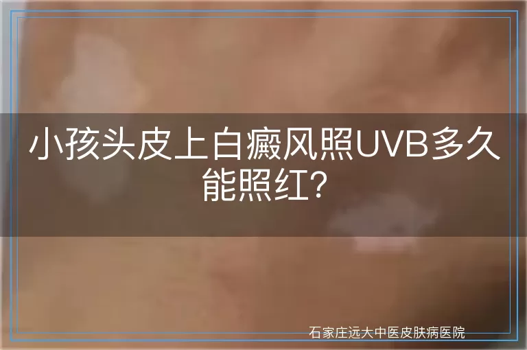 小孩头皮上白癜风照UVB多久能照红？