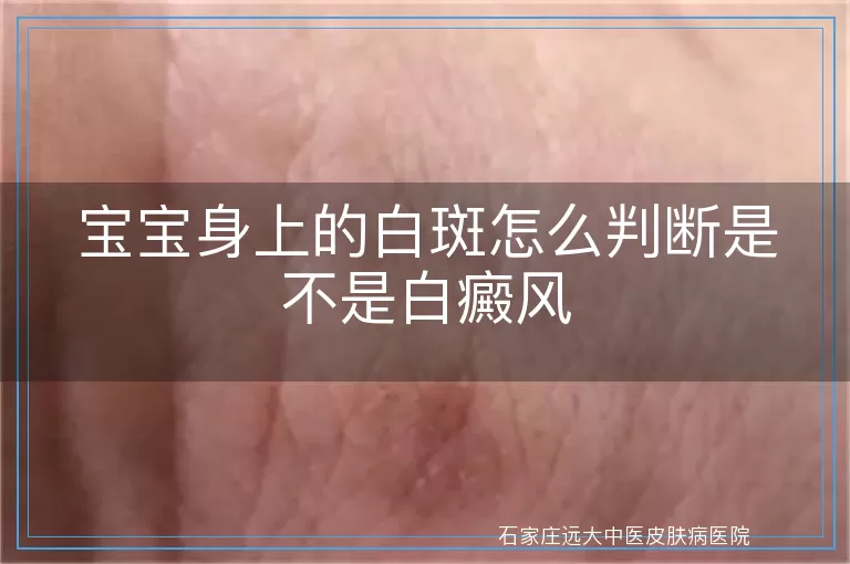 宝宝身上的白斑怎么判断是不是白癜风