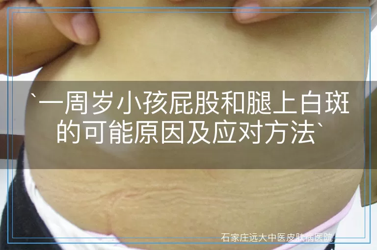 `一周岁小孩屁股和腿上白斑的可能原因及应对方法`