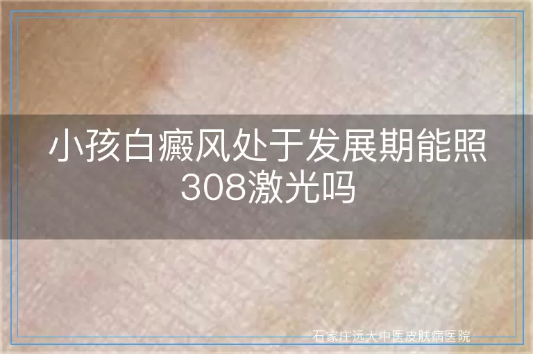 小孩白癜风处于发展期能照308激光吗